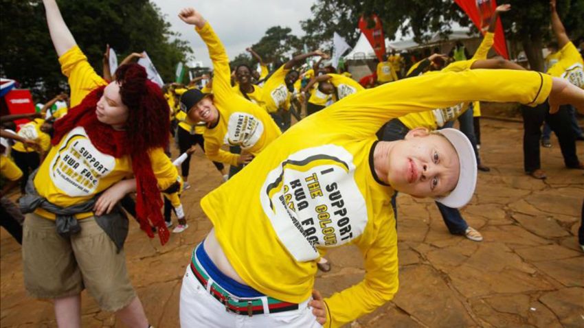 tLMD-albino-albinos-en-nairobi-kenia-EFE-11107664w