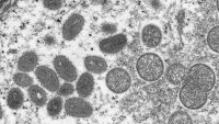 La OMS cambia el nombre de la viruela del mono a mpox; los CDC aceptan ese uso