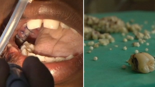 Video: ¡Insólito! le sacan 232 dientes a joven